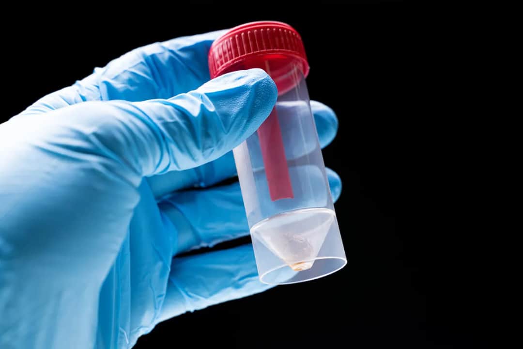 Jak pobrać wymaz kału do sanepidu - uniknij błędów i komplikacji